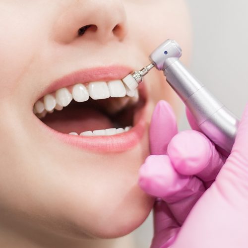dentist-brushes-teeth-young-girl-teeth-whitening-2022-11-15-05-20-50-utc ESTÉTICA DENTAL Y BLANQUEAMIENTO